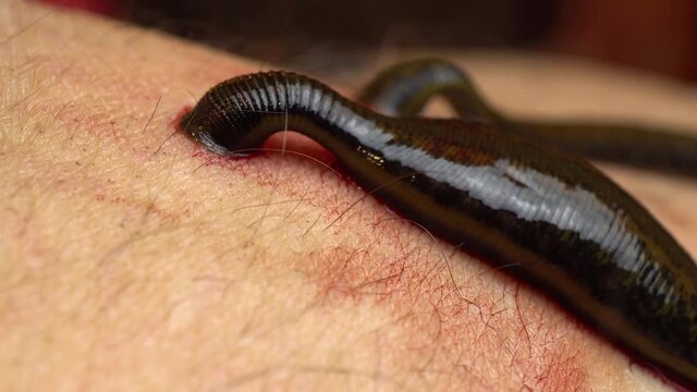 Medical leeches on the human body drink blood. Treatment with leeches. Macro video.