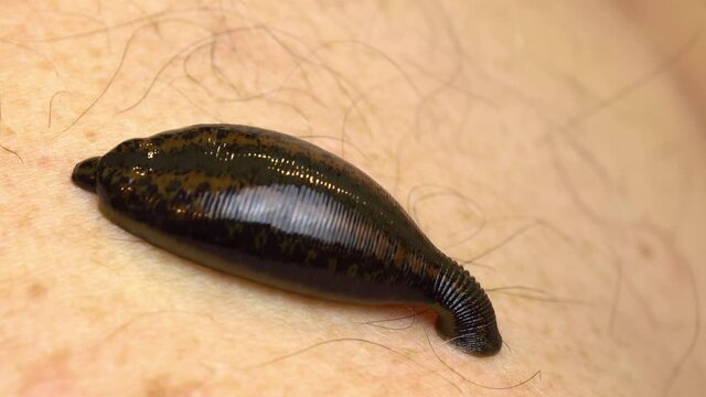 Medical leech on the human body drink blood. Treatment with leeches. Macro video.