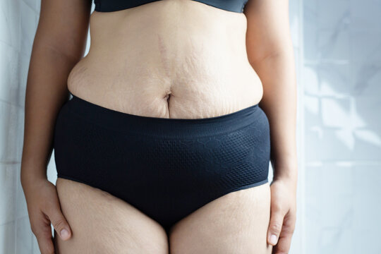 Obese women have excess fat, she wants to lose weight and control weight.