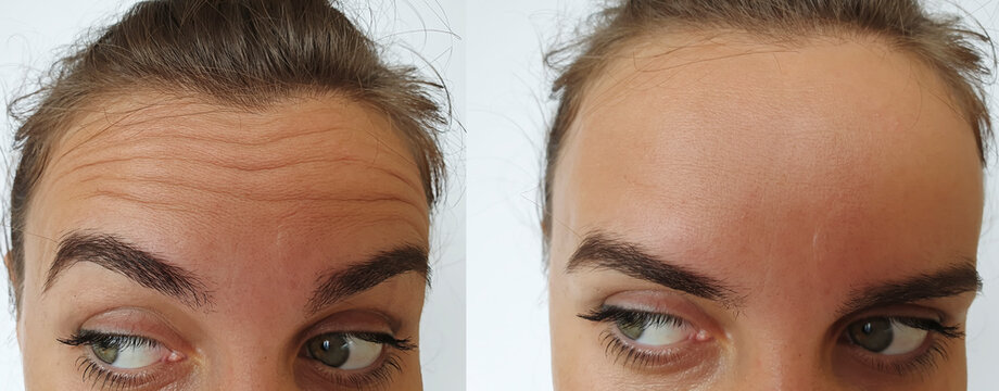 Woman Forehead Wrinkles Before And After Treatment