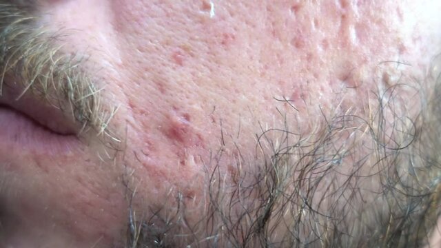 Close up on man face with problematic skin on his cheeks. Bearded young adult with acne problems. Redness, puffiness and pustules. Face inflammation on skin caused by allergy problems.