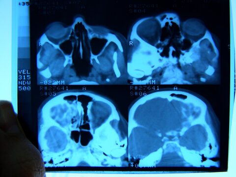 X-ray diagnostics of the head. Etmoiditis, sinusitis, nose disease.
