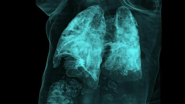 Chest radiography, Human lungs infected with covid-19. Ground-glass opacification opacity (GGO) in the lung on computed tomography