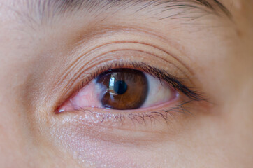 Close up of the pterygium during eye examination.