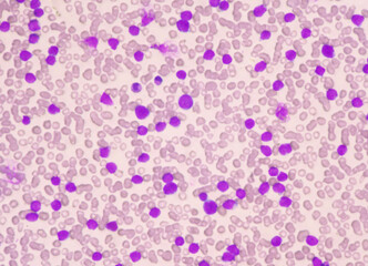 Moderate blast cell of white blood cells in blood smear.