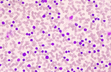 Moderate blast cell of white blood cells in blood smear.