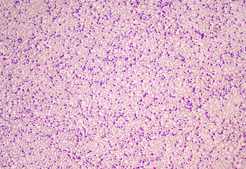 Moderate blast cell of white blood cells in blood smear.