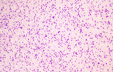 Moderate blast cell of white blood cells in blood smear.