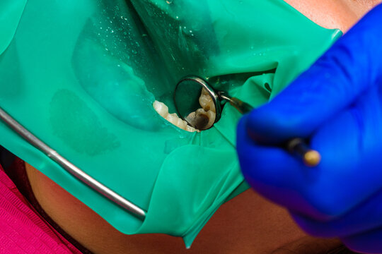 Treatment of posterior tooth, mouth covered with rubber dam, sterile treatment with modern technology.