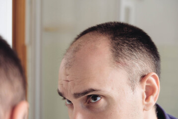 Young man looking at mirror worry about balding.