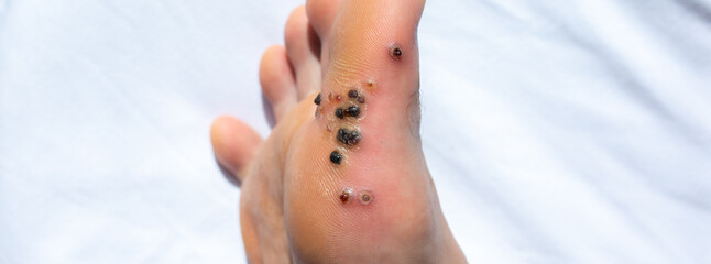 Wounds from removal of warts. Black scars. Contagious skin illness on foot. Medical treatment photo.
