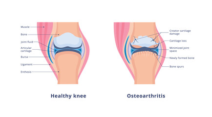 Vector banner with medical anatomy with knee osteoarthritis and normal joint