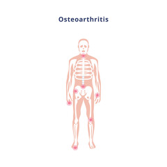 Diagram of body with joint damage by osteoarthritis, flat vector illustration.