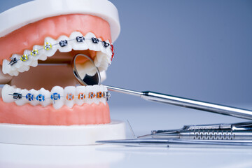 Orthodontics treatment. Orthodontic model and dentist tool - demonstration teeth model of varities of orthodontic bracket or brace. - obrazy, fototapety, plakaty