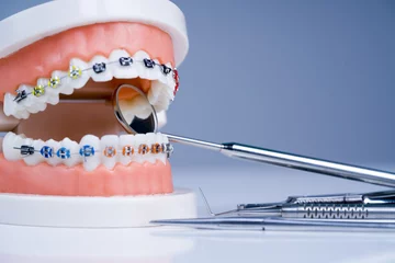 Orthodontics treatment. Orthodontic model and dentist tool - demonstration teeth model of varities of orthodontic bracket or brace. © Nikoletta