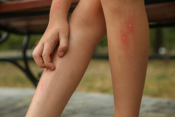 Naklejka premium Girl scratching leg with insect bite outdoors, closeup