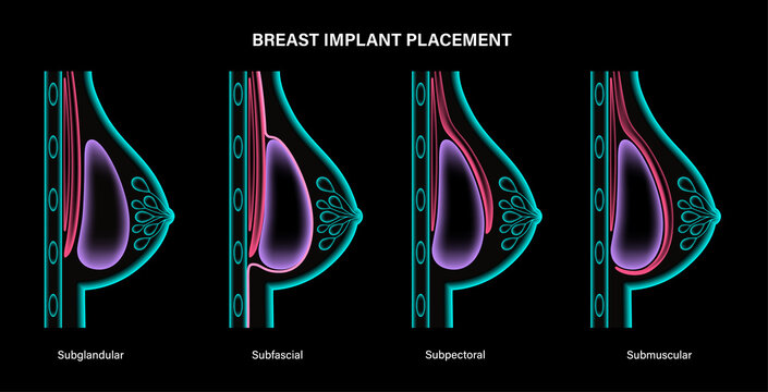 Breast Implant Concept