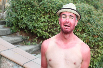 Man with pale complexion getting sunburnt 
