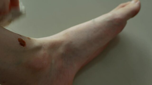 Closeup view of a person hand is scratching a patch of eczema on the leg.