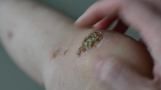 Closeup view of a person hand is scratching a patch of eczema on the knee.