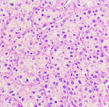 This photo reveals hepatocellular carcinoma with trabecular pattern, magnification 400x, photo under microscope