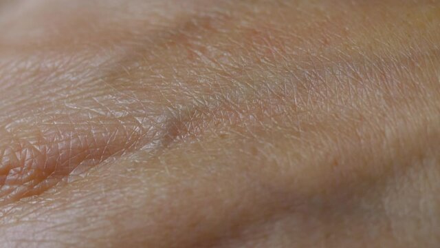 Macro Shot of Really Dry Old Human Skin. Close up Skin Texture With Wrinkles on Body Human Skin of Hand in Summer From Sunburn. Freckle Pigmentation Vein Allergy.