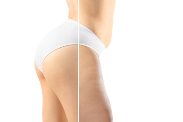 Overweight woman with cellulite legs and buttocks in white underwear comparing with fit and thin...