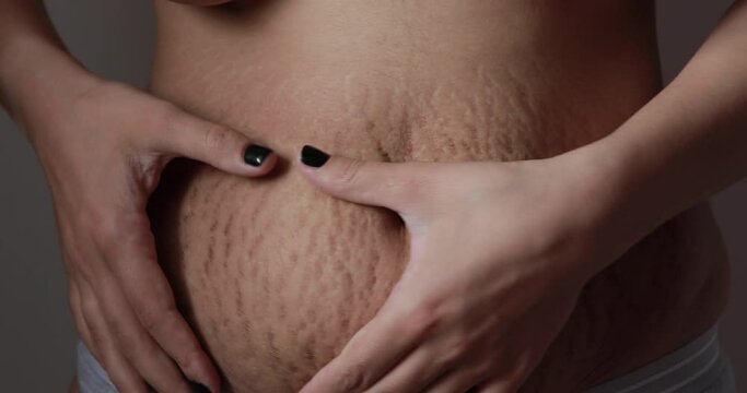 Close Up View Of The Back With stretch Marks On The Skin. The Concept Of  Impaired Skin Elasticity During Puberty Stock Photo, Picture and Royalty  Free Image. Image 141191300.