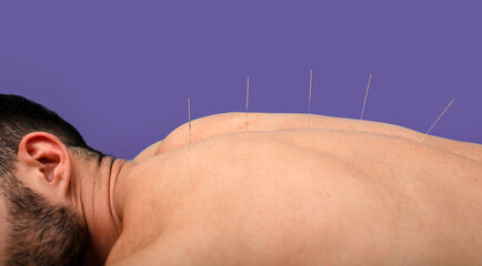 Man getting acupuncture treatment. Acupuncture needles close up on violet background