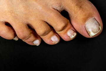 Toes of a female foot close-up with nails affected by a fungus on a black background. Foot health and hygiene. © Максим Травкин
