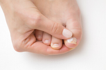 Young adult woman hand using and applying white moisturizing cream on foot nail. Dry, damaged toe...