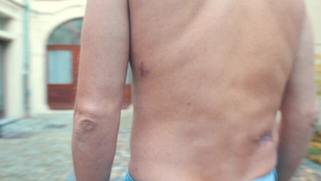 Scars on the male torso. Keloid is a benign fibrous growth, which presents in scar tissue of predisposed individuals. The patient's body after rehabilitation.