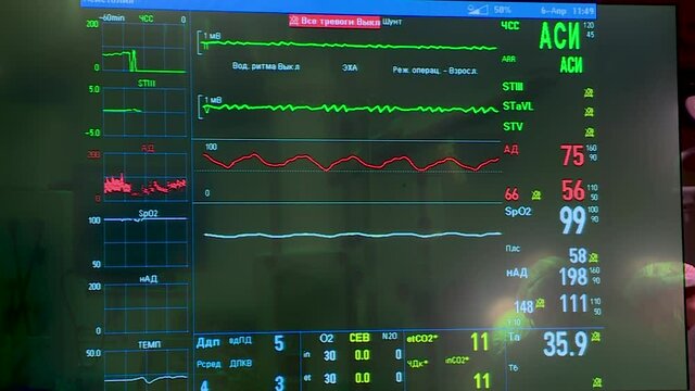 Monitor with vital signs of the patient during heart surgery.