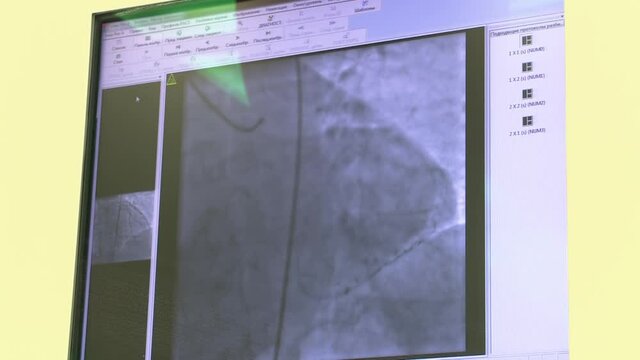 Monitor with indications of the input of contrast agent of the heart vessels.