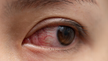 Closeup of irritated or infected red bloodshot eye - conjunctivitis. Red eye of woman,...