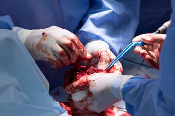 Surgery of Hand Amputation Closeup