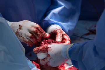 Surgeons work on amputated hand close-up