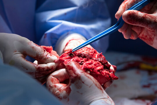 Amputation surgery close-up with electrosurgical forceps usage