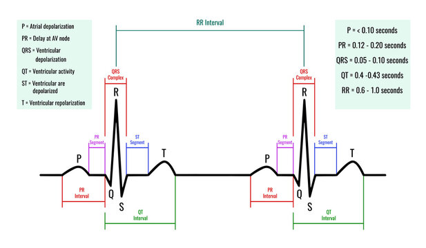 illustration of ECG interpretation. ECG of a healthy person.Useful for educating doctors and nurses.
