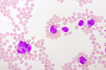 Acute promyelocytic leukemia cells or APL, analyze by microscope, original magnification 1000x