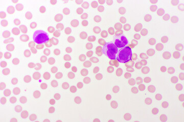Acute promyelocytic leukemia cells or APL, analyze by microscope, original magnification 1000x