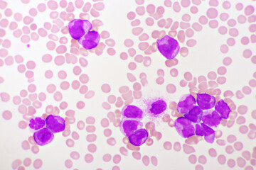 Acute promyelocytic leukemia cells or APL, analyze by microscope, original magnification 1000x