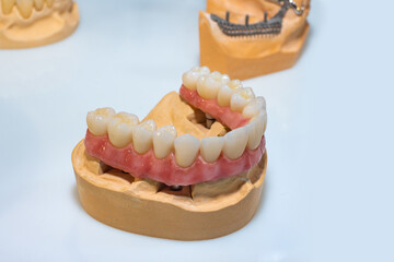 The manufacture of dental prostheses. Model of a man jaw with a prosthesis. Dental manual....