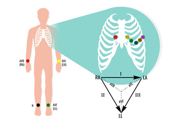 Ecg electrode position illustration with ecg limb leads. Useful for educating doctors and nurses.