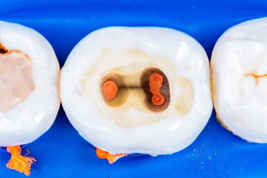isolated teeth with rubberdam