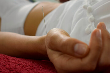 Acupuntura