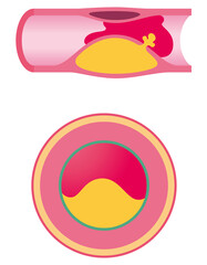 血管閉塞　動脈硬化の進行