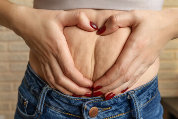 Woman make heart cellulite on belly. - obrazy, fototapety, plakaty