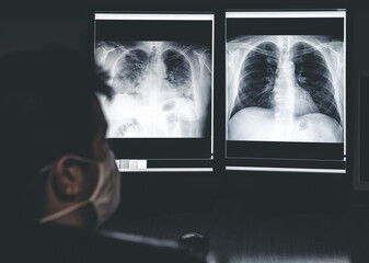 Radiologist looking at x-ray image of lungs of patient with coronavirus Covid-19