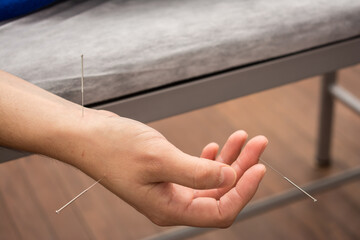 Acupuncture, the traditional chinese medicine